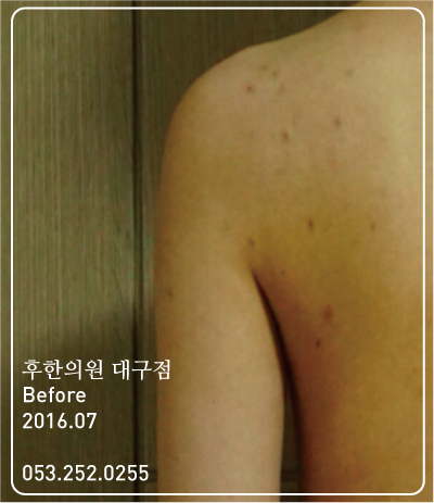 치료 전