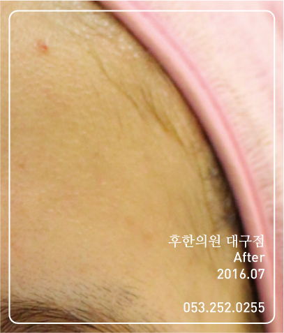 치료 후