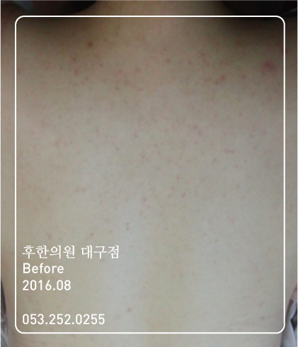 치료 전