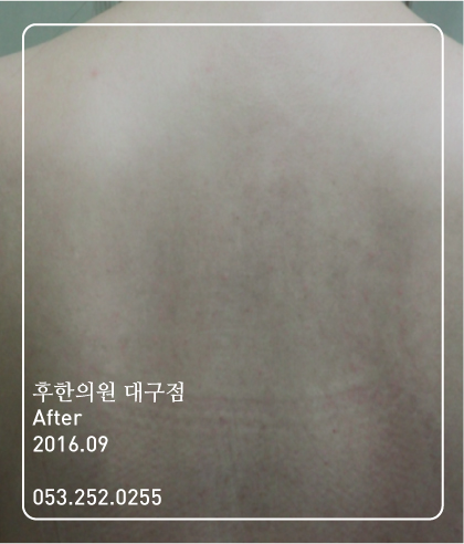 치료 후