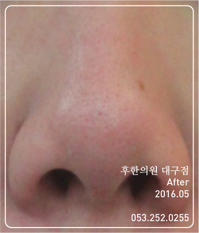 치료 후