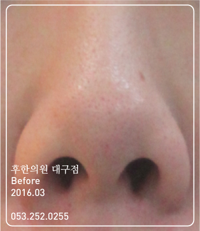 치료 전