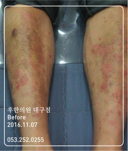 치료 전