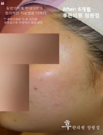 치료 후