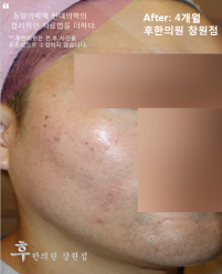 치료 후