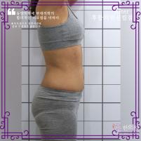 치료 후