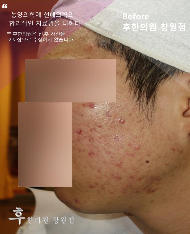 치료 전