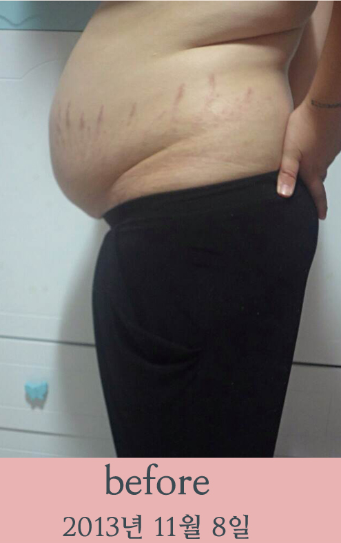 치료 전