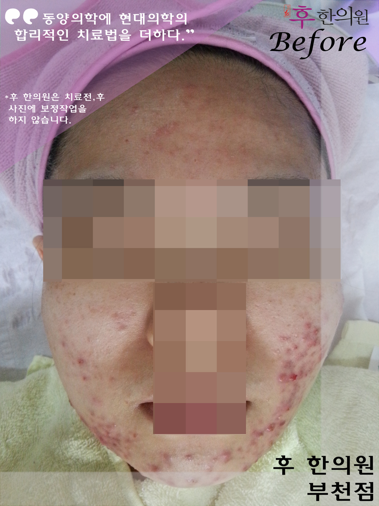 치료 전