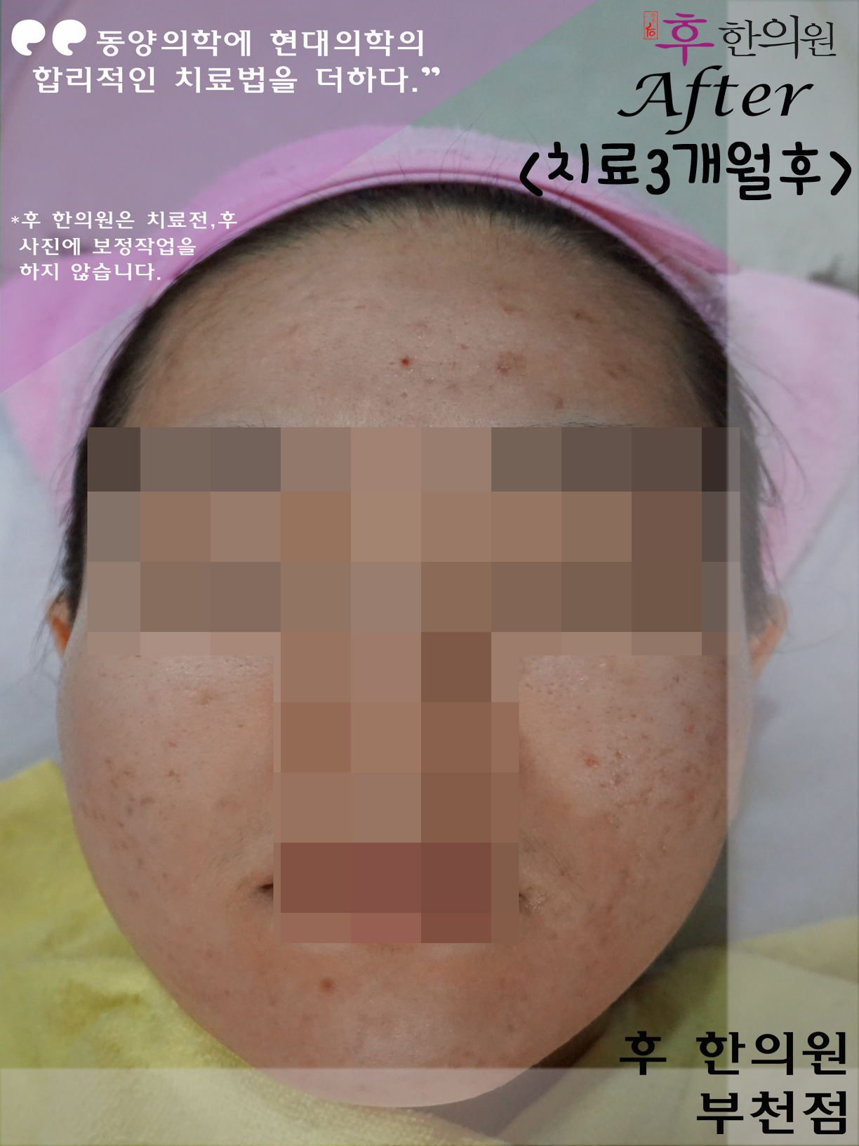 치료 후