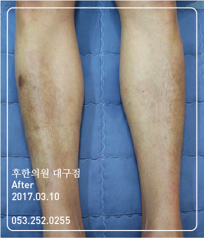 치료 후