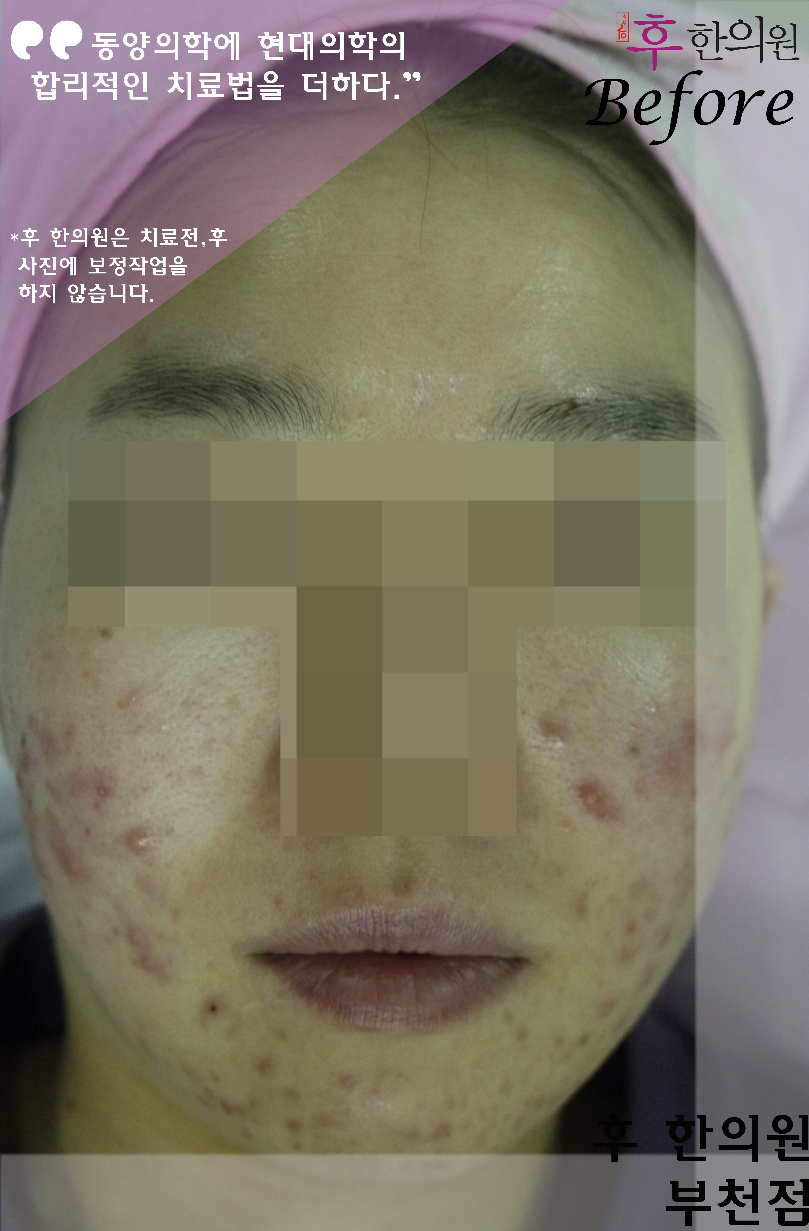 치료 전
