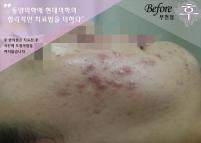 치료 전