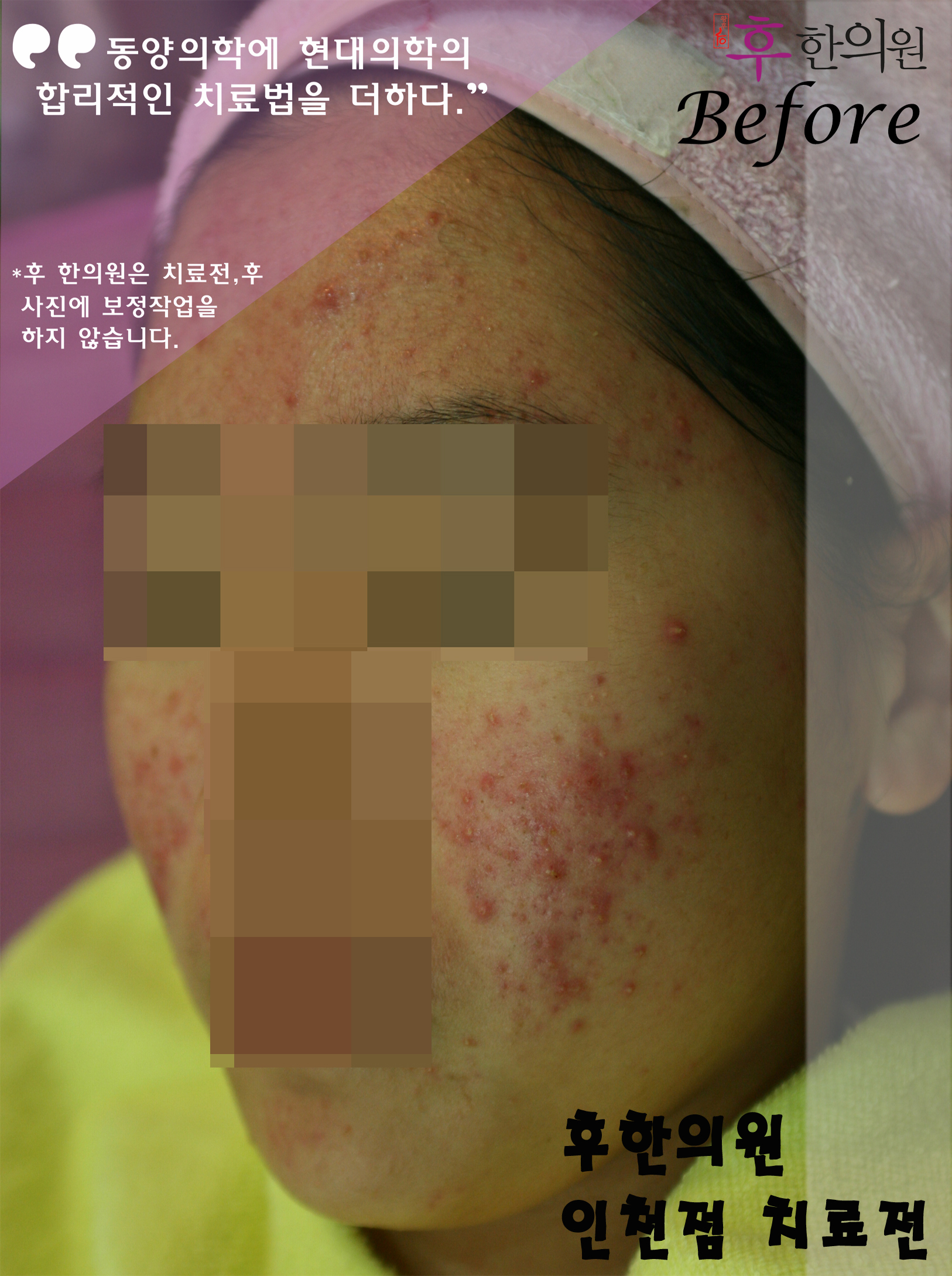 치료 전