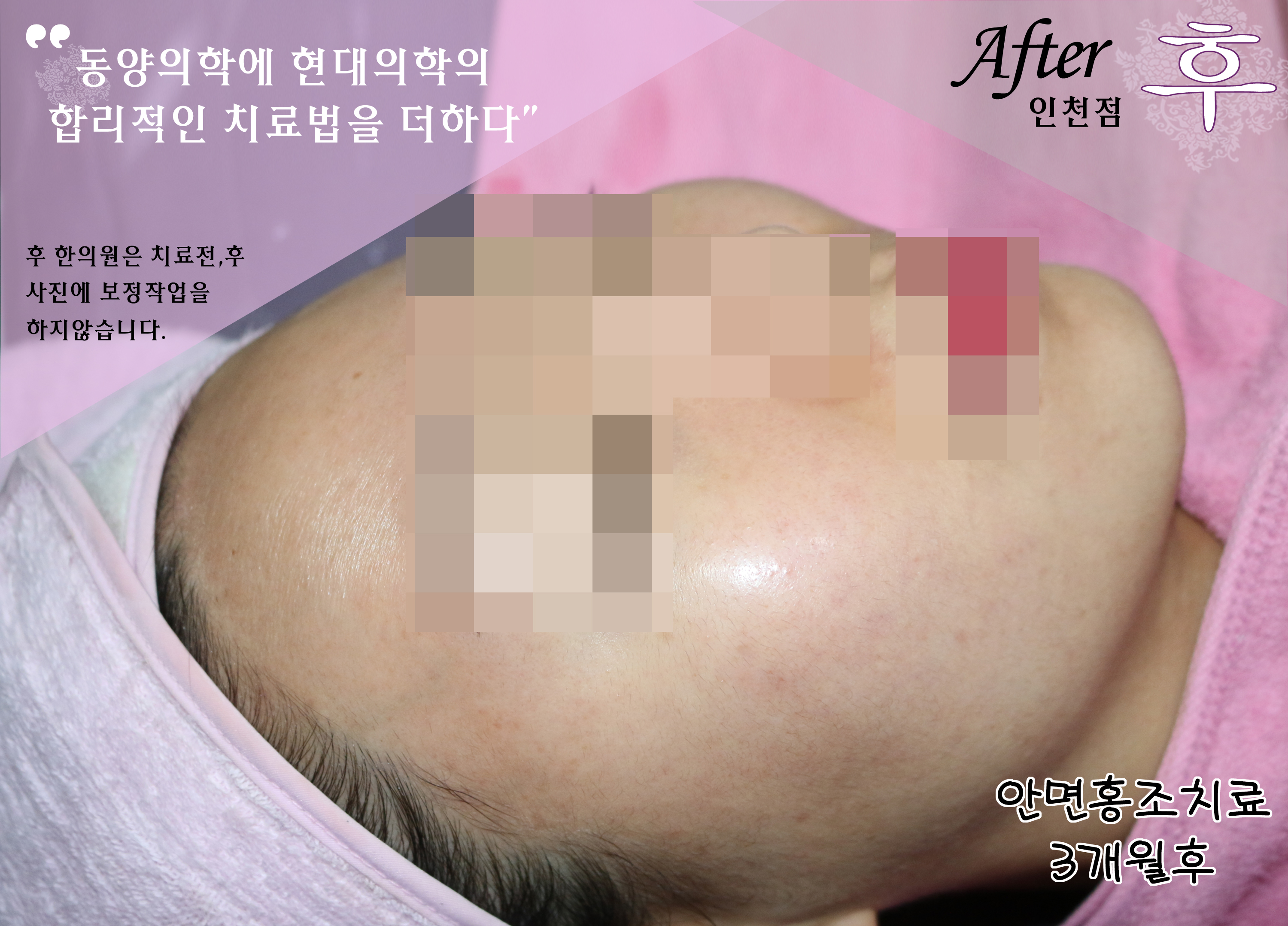 치료 후