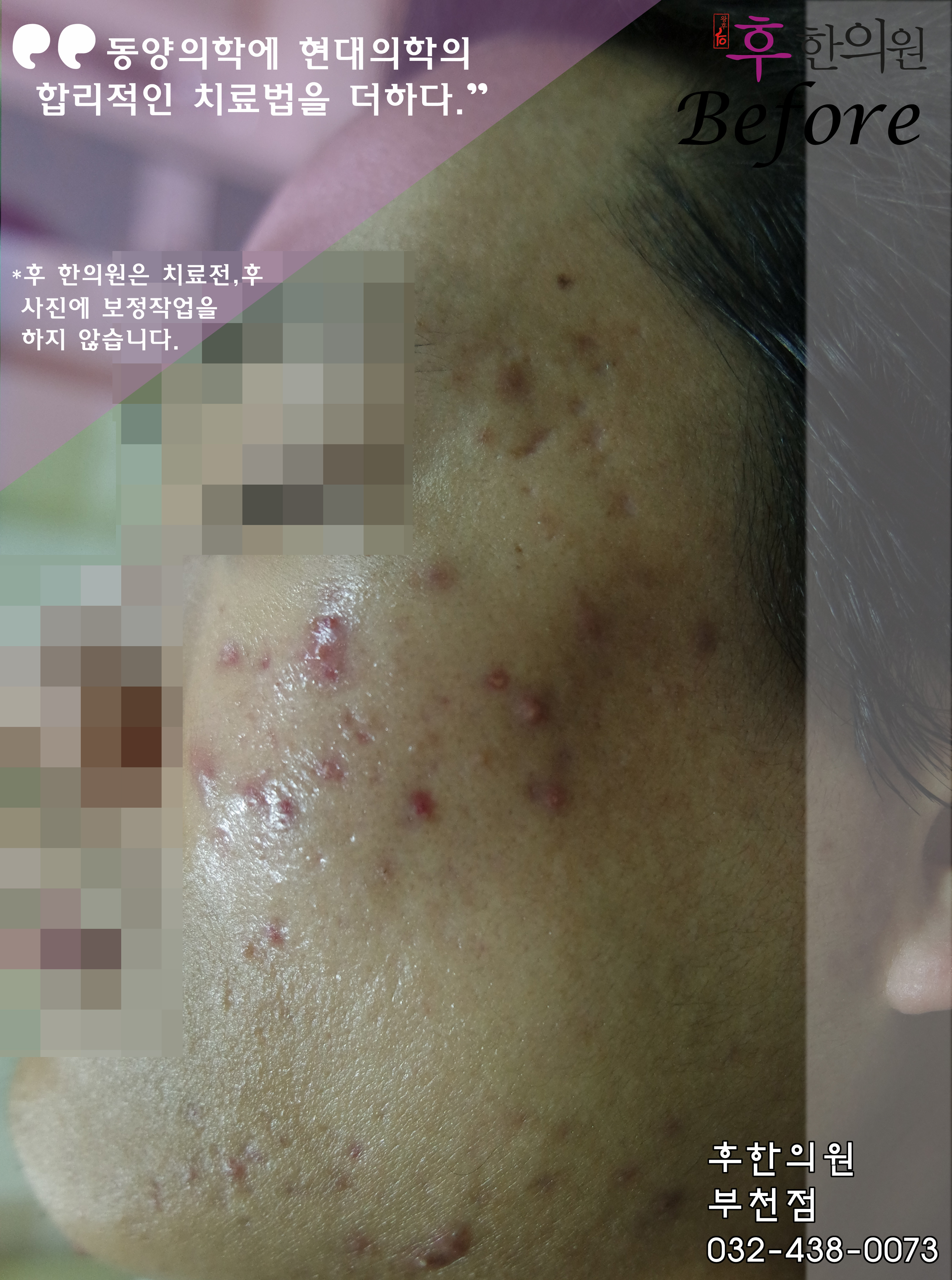 치료 전