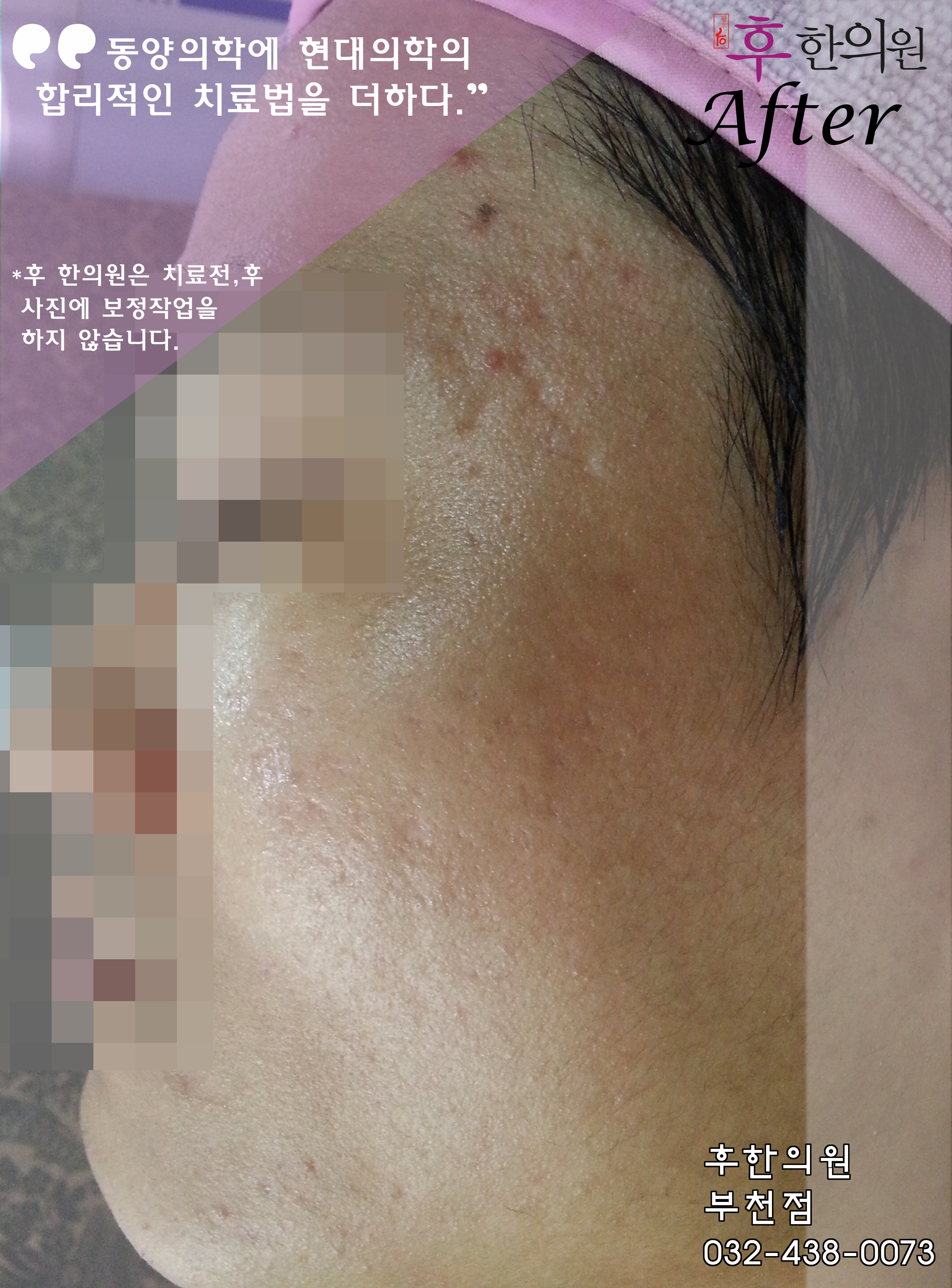 치료 후