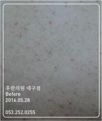 치료 전