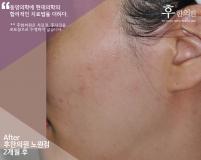 치료 후