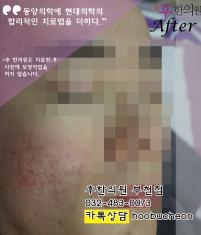 치료 후