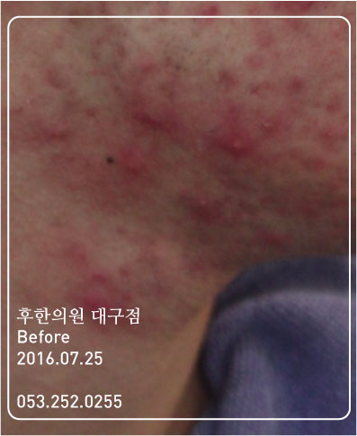 치료 전
