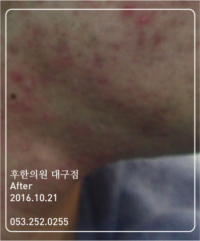 치료 후