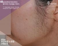 치료 후