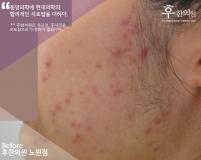 치료 전