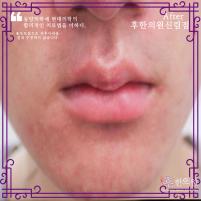 치료 후
