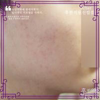 치료 후