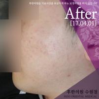 치료 후