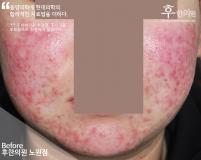 치료 전