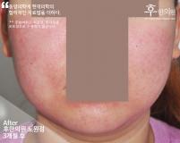 치료 후