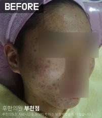 치료 전