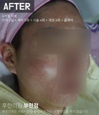 치료 후