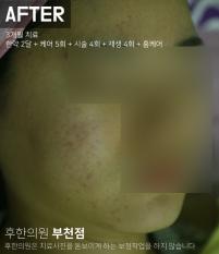 치료 후