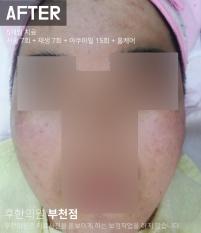 치료 후