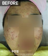 치료 전