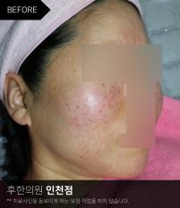 치료 전