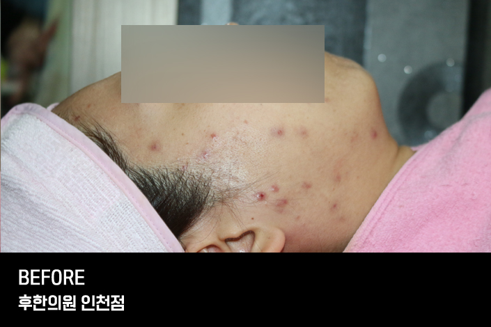 치료 전