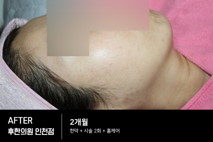 치료 후