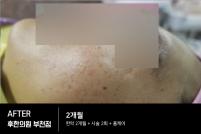 치료 후