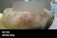 치료 전