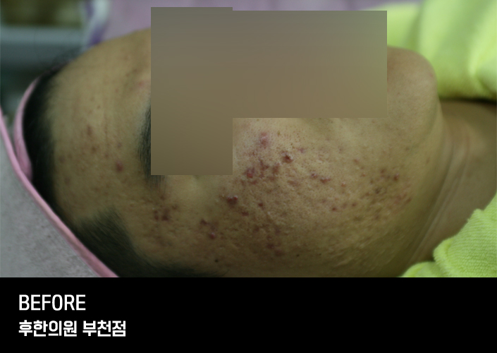 치료 전