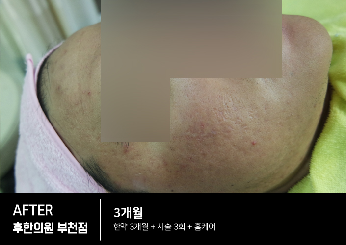 치료 후