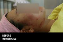 치료 전