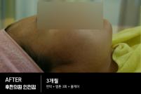 치료 후