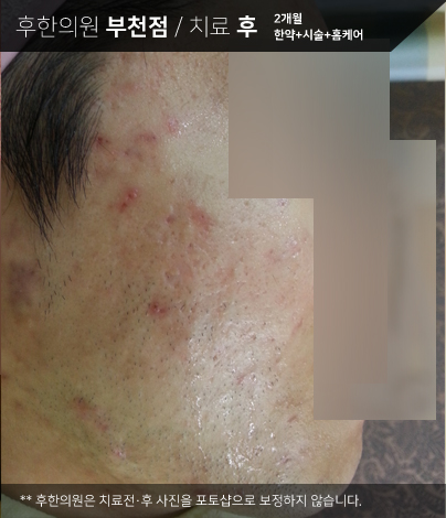 치료 후