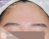 치료 후