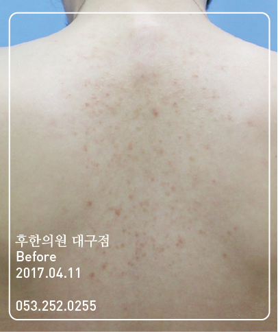 치료 전